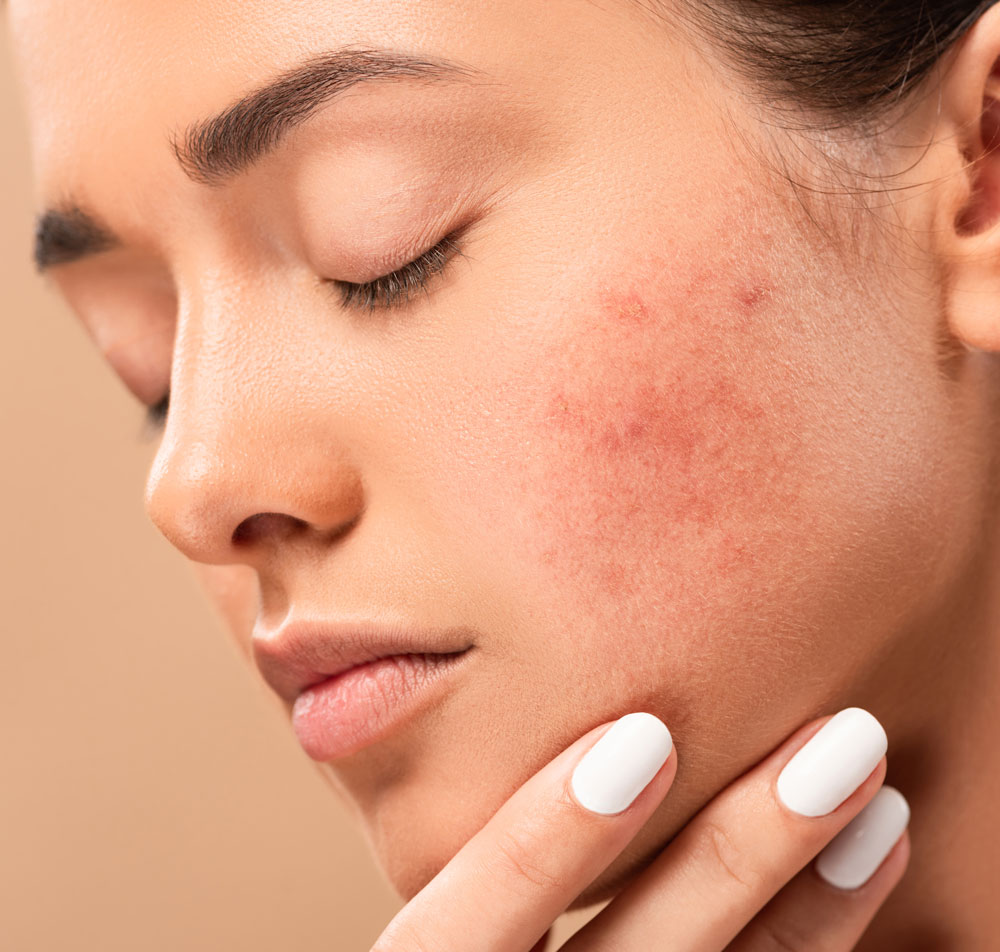 Woman with visible acne and breakouts on cheek.
