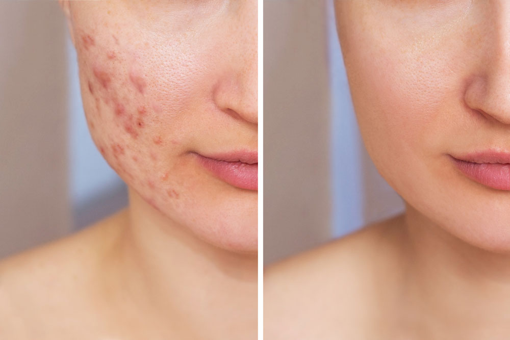 Before and after results of acne and breakouts treatment.