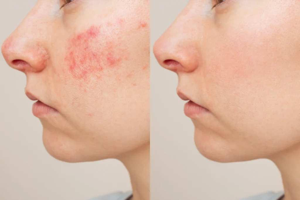 Acne facials before and after results on cheek.