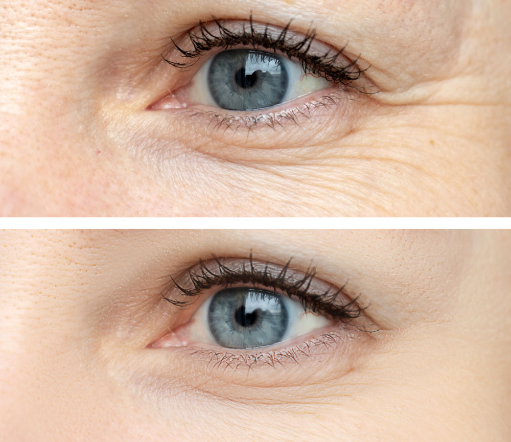 Before and after close-up of eye area reducing aging and wrinkles.