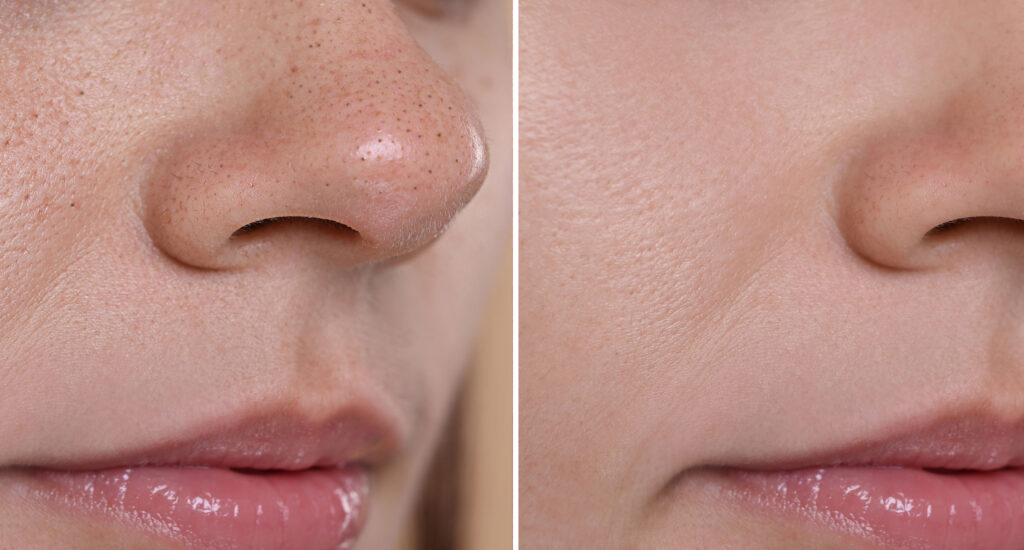 Before and after image showing reduction of enlarged pores and blackheads.