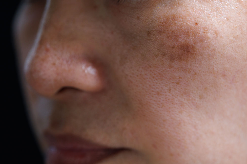 Close-up of facial skin with visible hyperpigmentation and dark spots.