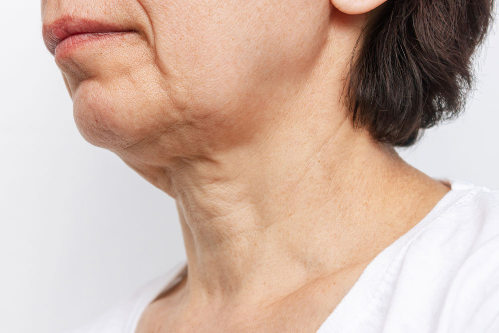 Profile view of mature woman showing signs of loss of elasticity and sagging skin.