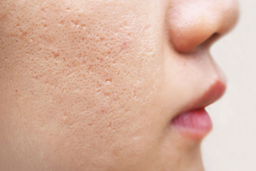Close-up of facial skin with visible scarring and texture issues.