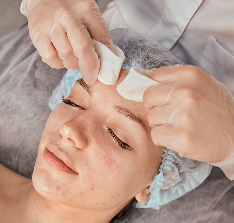 Facial treatment being performed to improve scarring and texture issues.