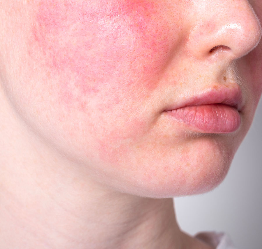 Close-up of cheek with redness due to sensitive skin and rosacea.