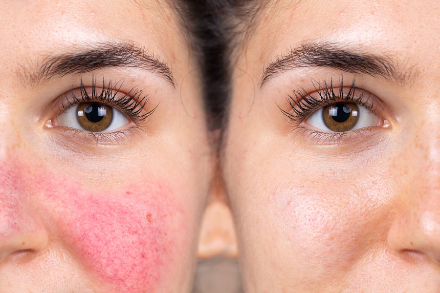 Before and after treatment results of sensitive skin and rosacea.