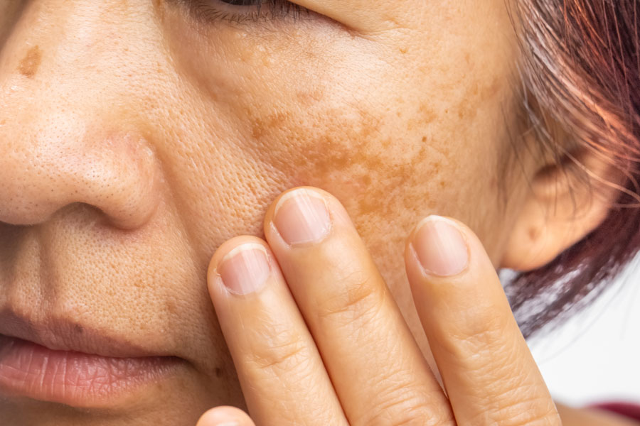 Detailed close-up of sun-damaged skin with visible wrinkles and discoloration due to prolonged sun damage uv exposure.