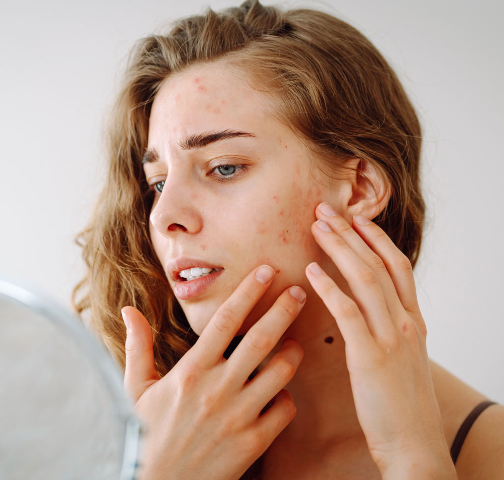 Woman examining red blemishes on face caused by sun damage and UV exposure.