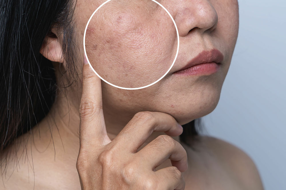 Close-up of face showing signs of uneven skin tone and dullness.