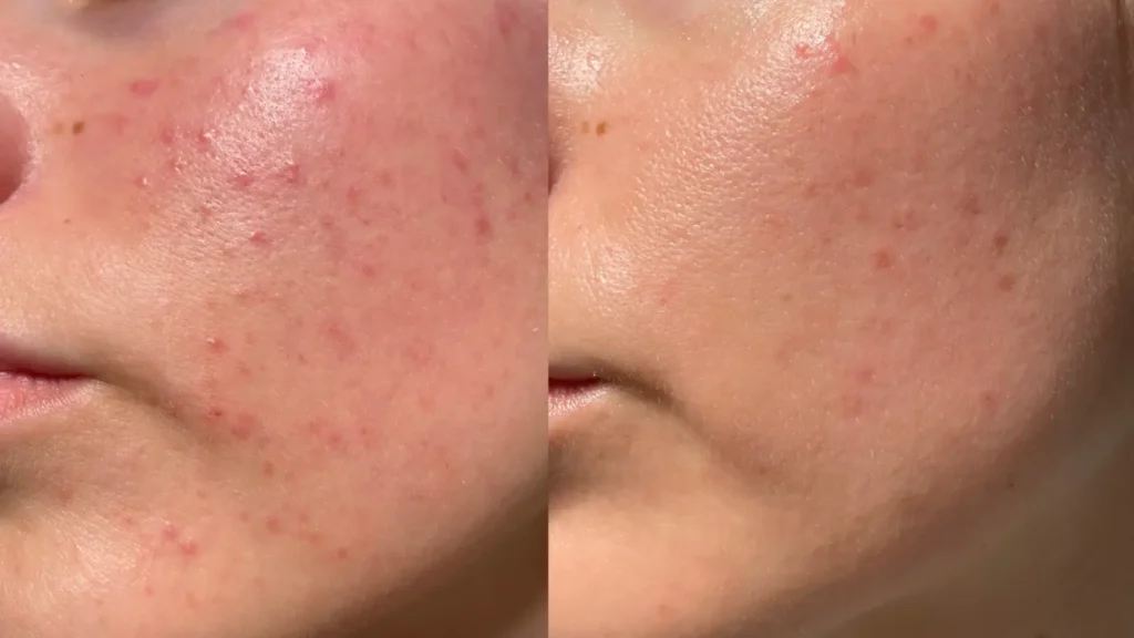 Side-by-side comparison of cheek with acne and clearer skin
