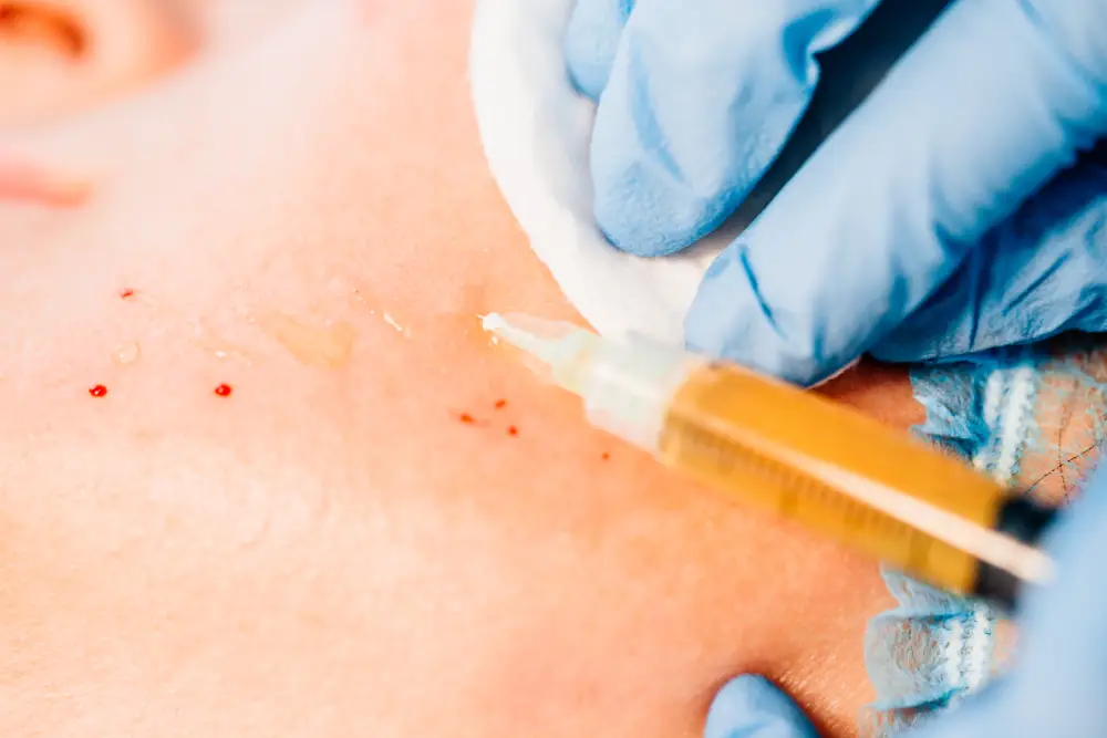 Close-up of PRP being injected into the skin during a vampire facial treatment.